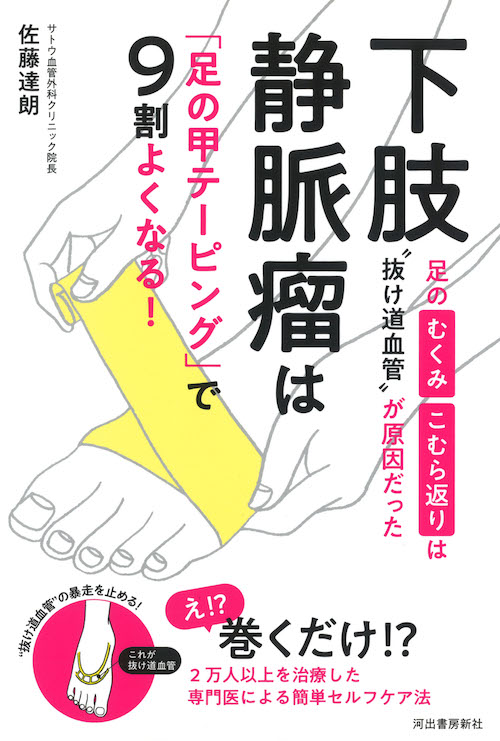 下肢静脈瘤は「足の甲テーピング」で９割よくなる！